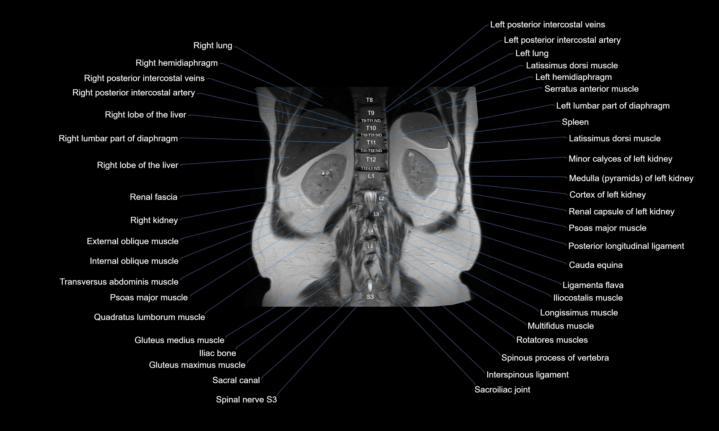 MRI Abdomen axial cross sectional anatomy radiology  image-img-00001-00045.webp